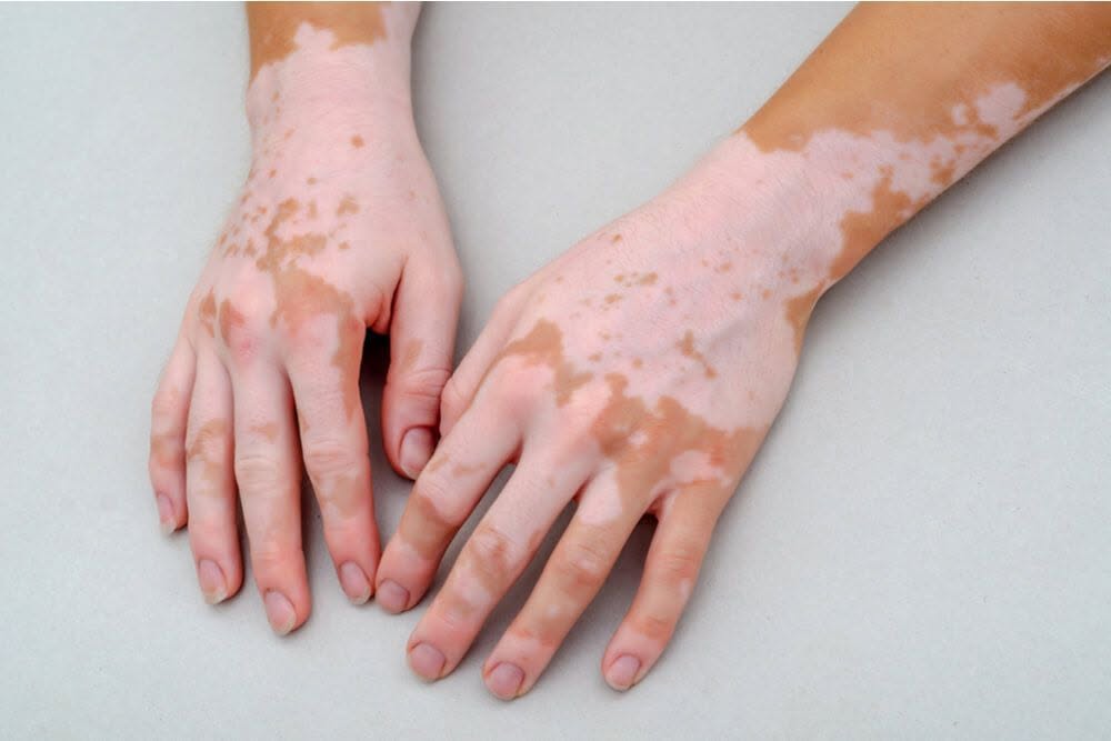 Vitiligo Care